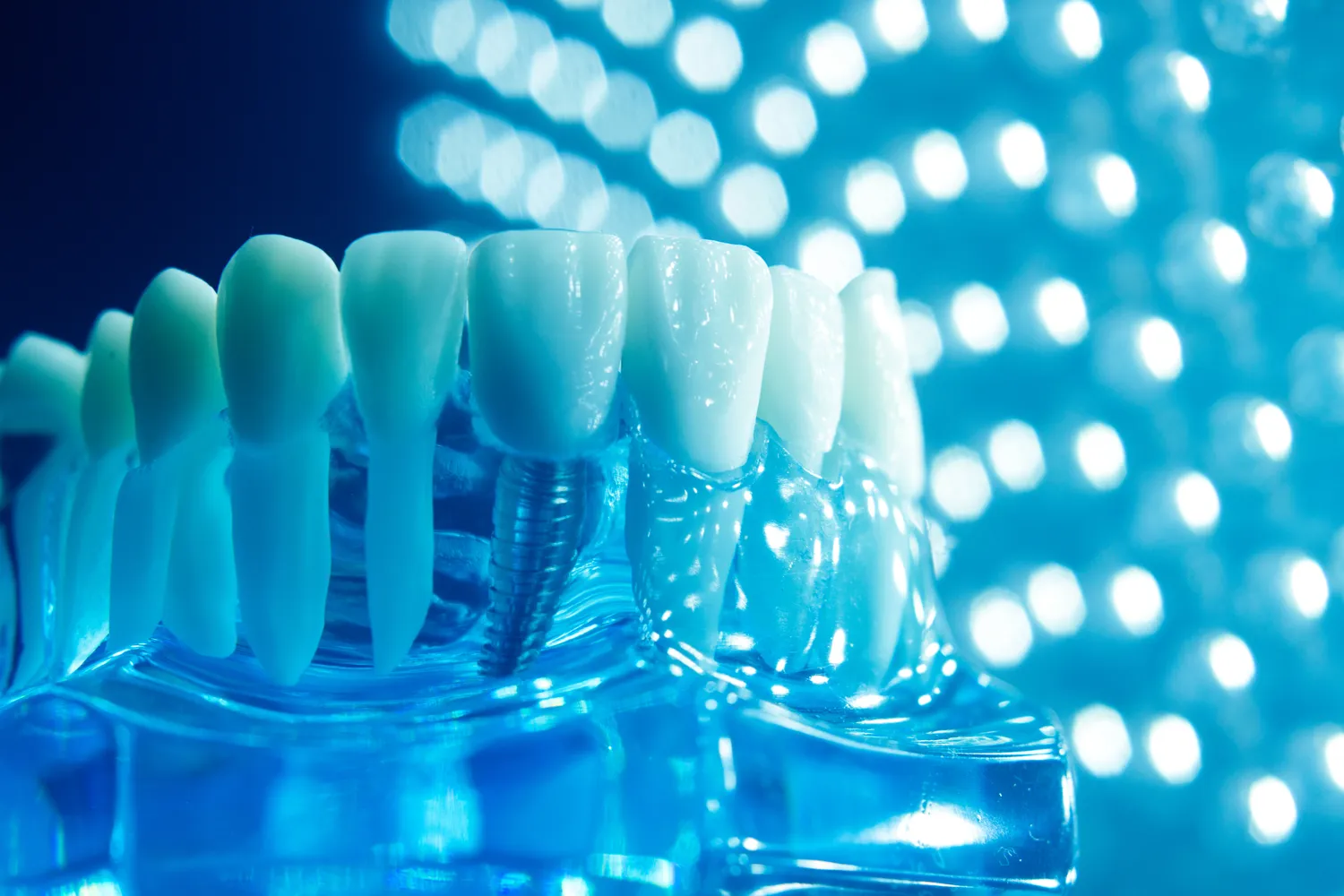 Implanty ile kosztują?