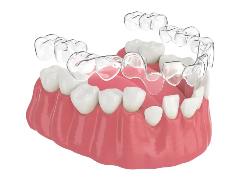 Invisalign kiedy efekty?